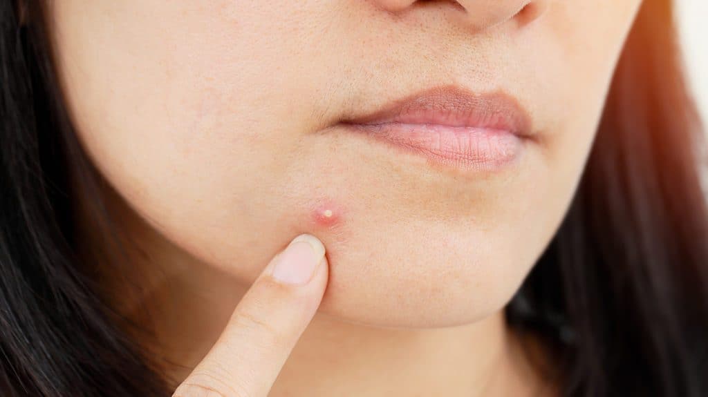 How to get rid of cheek acne? NETGENICS